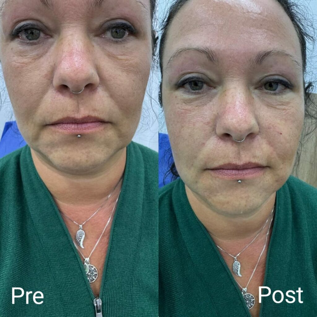 فيلر الخدود